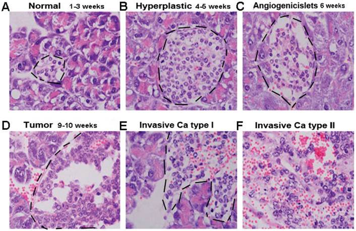 Micrometastasis Expressing Insulin Arise in Lung and Spleen at Advanced
