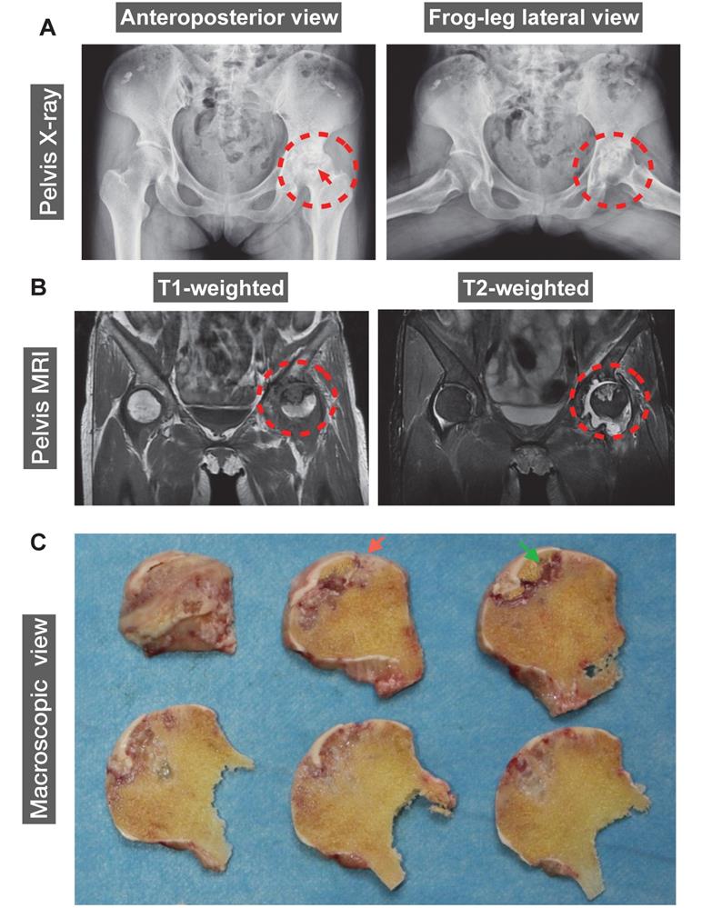 Steroid-induced osteonecrosis of the femoral head reveals enhanced
