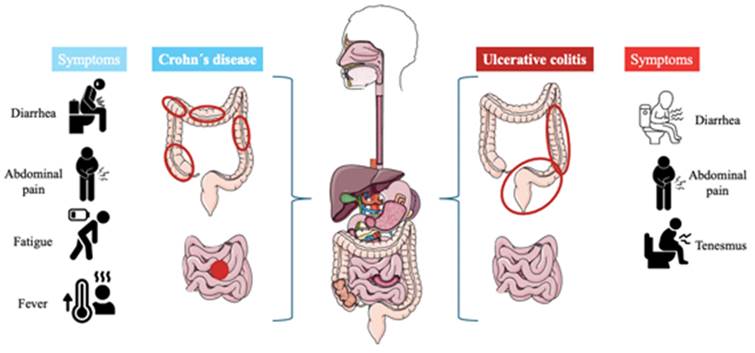 Harnessing the Anti-Inflammatory Properties of Polyphenols in the Treatment of Inflammatory Bowel Disease